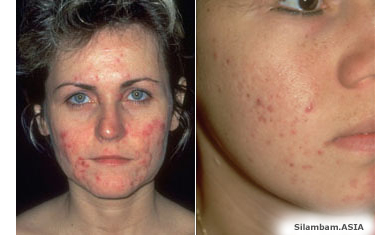 Acne Acne