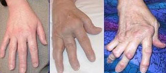 Arthrite Rhumatoide Arthrite Rhumatoide