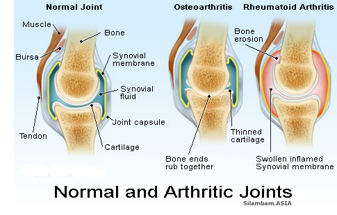 Arthritis Arthritis