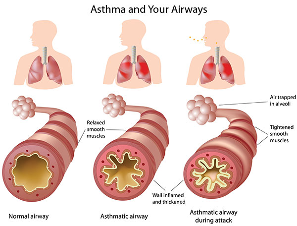 Asthma 2 Asthma 2