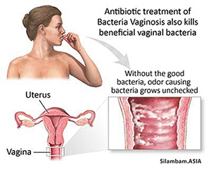 bacterial vaginosis 2 bacterial vaginosis 2