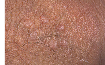 Genital Warts Genital Warts