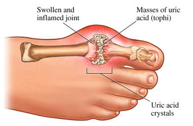 Gout Gout
