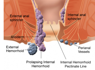 Hemorrhoids 1 Hemorrhoids 1