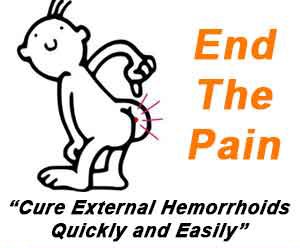 Hemorrhoids 2 Hemorrhoids 2