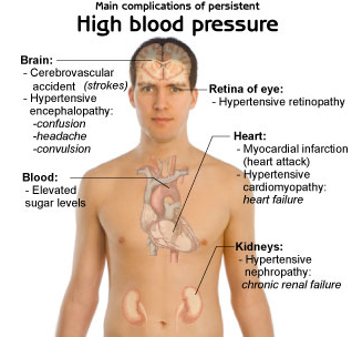 High Blood Pressure 3 High Blood Pressure 3