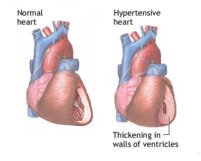 Hypertension 2 Hypertension 2