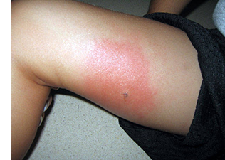 Insect Bites Insect Bites