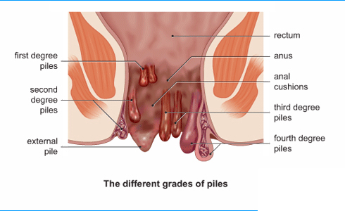 Piles Piles