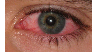 Pink Eyes Pink Eyes