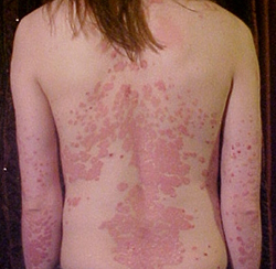 Psoriasis Psoriasis