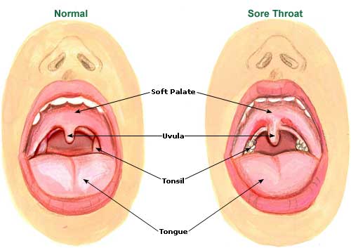 Sore Throat 2 Sore Throat 2