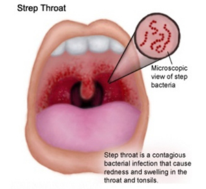 Strep Throat Strep Throat