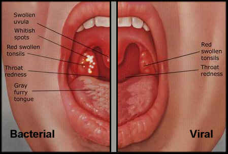 Strep Throat 2 Strep Throat 2