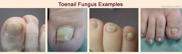 Toe Nail Fungus Toe Nail Fungus