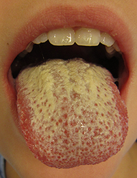 Yeast Infection - Candidiasis Yeast Infection - Candidiasis